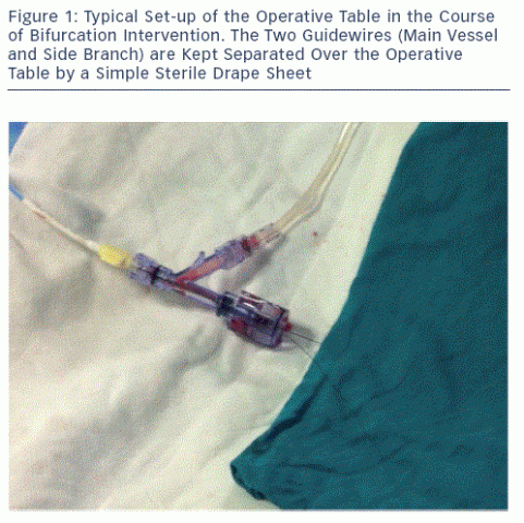 Technical Aspects Of Provisional Stenting In Percutaneous Treatment Of ...